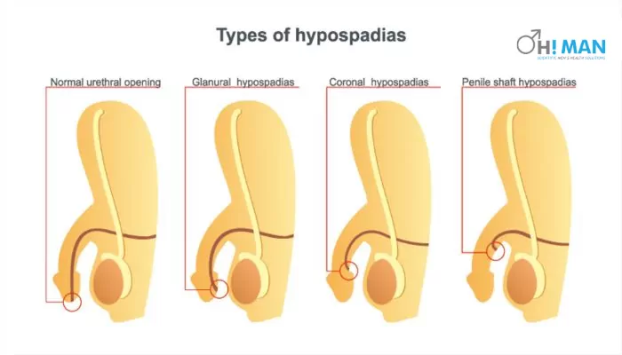types of penile hypospadias